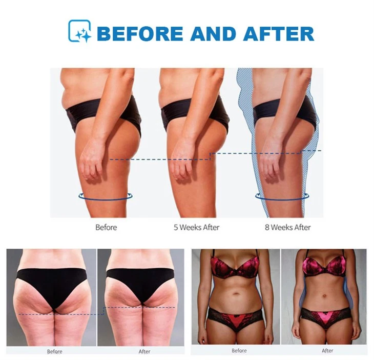 Best Ems Body Sculpt Machine