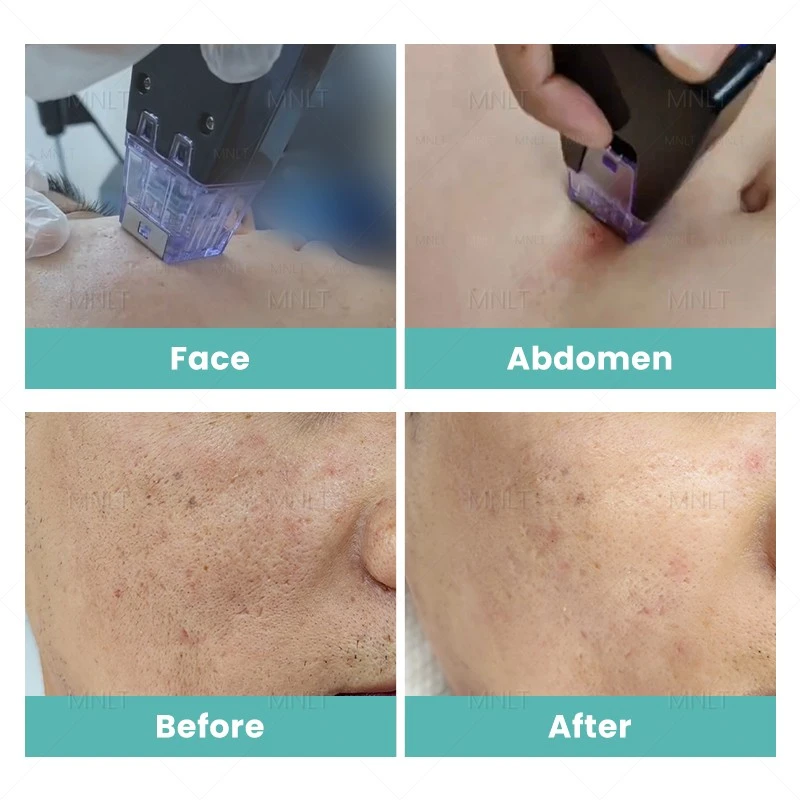Crystallite Depth 8 RF Microneedling Machine – Advanced Skin Tightening & Body Remodeling Solution best